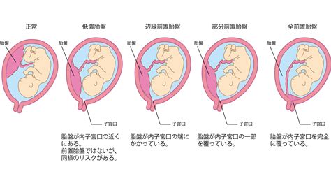 低位胎盤|「低置胎盤」の赤ちゃんへの影響・出産リスクはご存。